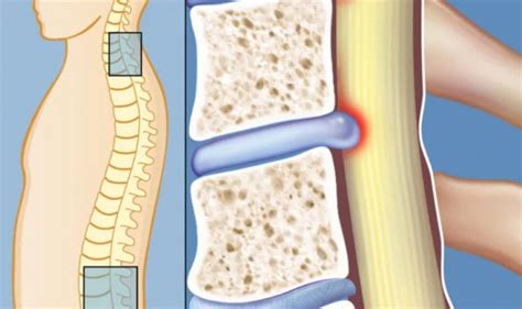 ЛФК при остеохондроза на шийния и лумбалния гръбначен стълб